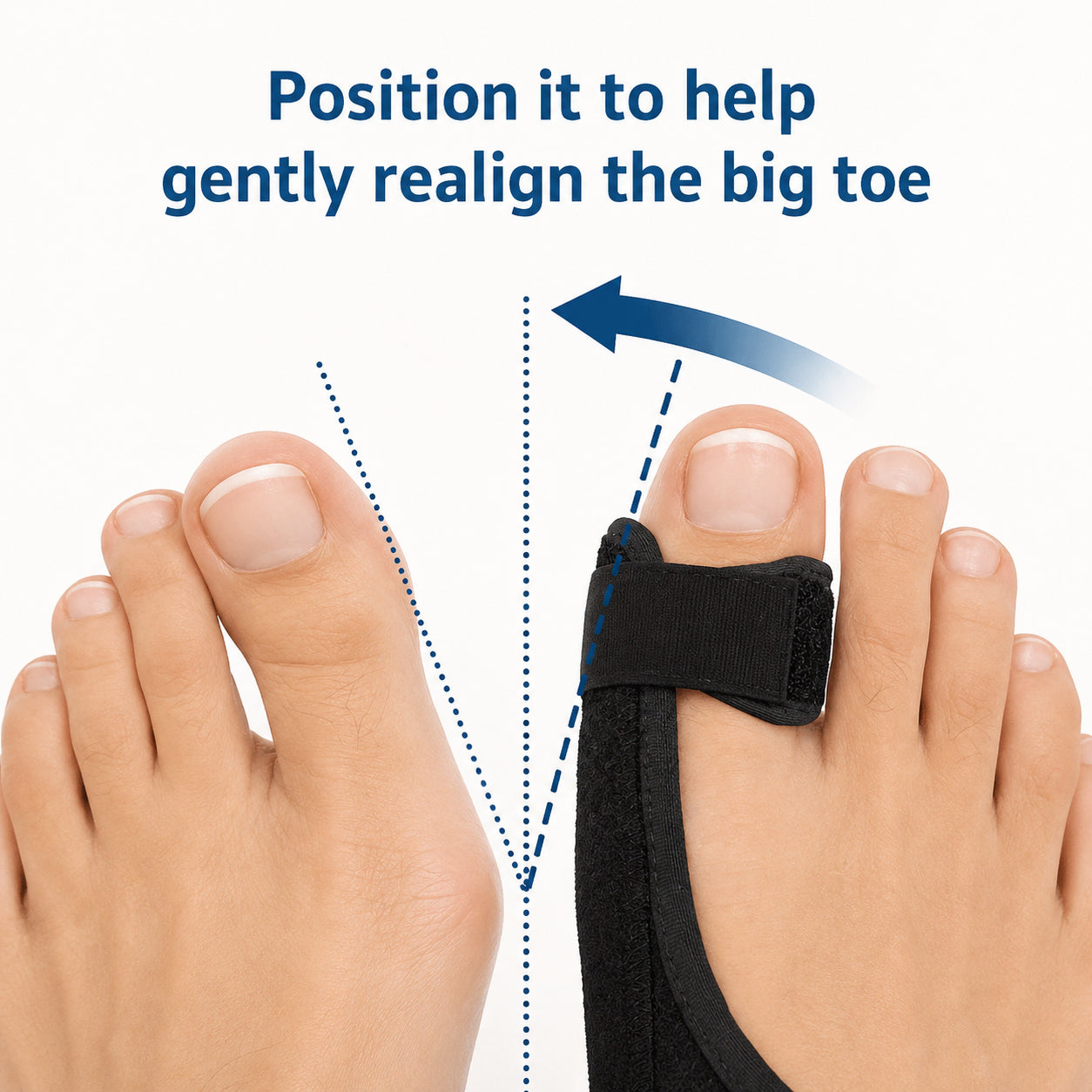 Infografik som visar hur en hallux valgus-nattskena hjälper till att rikta stortån mot en mer naturlig position för ökat stöd och avlastning.