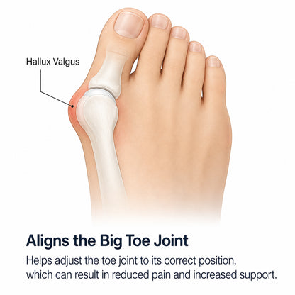 Illustration montrant comment un soutien pour hallux valgus aide à redresser l'articulation du gros orteil et à réduire la pression sur l'oignon du pied.